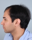 Before Hair Transplant&nbsp;Front